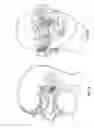 Fig. 02 - SINUPLASTY DEVICE