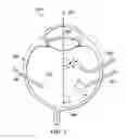Fig. 04 - Systems and methods using a vitreous visualization tool