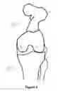 Fig. 03 - Determining a range of motion of an artificial knee joint