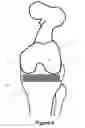 Fig. 10 - Determining a range of motion of an artificial knee joint