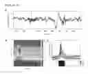 Fig. 04 - Feedback brain stimulation to enhance sleep spindles, modulate memory and cognitive function, and treat psychiatric and neurological symptoms