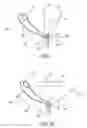 Fig. 02 - Suture anchor assembly and method of passing same suture multiple times