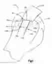 Fig. 02 - Soft tissue fixation system