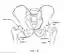 Fig. 03 - Method and apparatus for treating a joint, including the treatment of cam-type femoroacetabular impingement in a hip joint and pincer-type femoroacetabular impingement in a hip joint