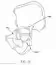 Fig. 06 - Method and apparatus for treating a joint, including the treatment of cam-type femoroacetabular impingement in a hip joint and pincer-type femoroacetabular impingement in a hip joint