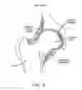 Fig. 07 - Method and apparatus for treating a joint, including the treatment of cam-type femoroacetabular impingement in a hip joint and pincer-type femoroacetabular impingement in a hip joint