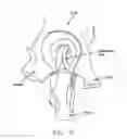 Fig. 08 - Method and apparatus for treating a joint, including the treatment of cam-type femoroacetabular impingement in a hip joint and pincer-type femoroacetabular impingement in a hip joint