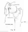 Fig. 09 - Method and apparatus for treating a joint, including the treatment of cam-type femoroacetabular impingement in a hip joint and pincer-type femoroacetabular impingement in a hip joint