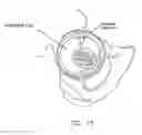 Fig. 16 - Method and apparatus for treating a joint, including the treatment of cam-type femoroacetabular impingement in a hip joint and pincer-type femoroacetabular impingement in a hip joint