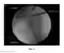 Fig. 22 - Method and apparatus for treating a joint, including the treatment of cam-type femoroacetabular impingement in a hip joint and pincer-type femoroacetabular impingement in a hip joint
