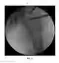 Fig. 28 - Method and apparatus for treating a joint, including the treatment of cam-type femoroacetabular impingement in a hip joint and pincer-type femoroacetabular impingement in a hip joint