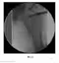 Fig. 30 - Method and apparatus for treating a joint, including the treatment of cam-type femoroacetabular impingement in a hip joint and pincer-type femoroacetabular impingement in a hip joint