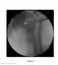 Fig. 33 - Method and apparatus for treating a joint, including the treatment of cam-type femoroacetabular impingement in a hip joint and pincer-type femoroacetabular impingement in a hip joint