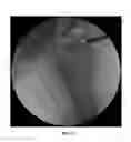Fig. 41 - Method and apparatus for treating a joint, including the treatment of cam-type femoroacetabular impingement in a hip joint and pincer-type femoroacetabular impingement in a hip joint