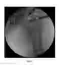 Fig. 43 - Method and apparatus for treating a joint, including the treatment of cam-type femoroacetabular impingement in a hip joint and pincer-type femoroacetabular impingement in a hip joint