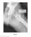 Fig. 44 - Method and apparatus for treating a joint, including the treatment of cam-type femoroacetabular impingement in a hip joint and pincer-type femoroacetabular impingement in a hip joint