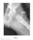 Fig. 45 - Method and apparatus for treating a joint, including the treatment of cam-type femoroacetabular impingement in a hip joint and pincer-type femoroacetabular impingement in a hip joint