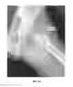 Fig. 46 - Method and apparatus for treating a joint, including the treatment of cam-type femoroacetabular impingement in a hip joint and pincer-type femoroacetabular impingement in a hip joint