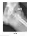 Fig. 47 - Method and apparatus for treating a joint, including the treatment of cam-type femoroacetabular impingement in a hip joint and pincer-type femoroacetabular impingement in a hip joint