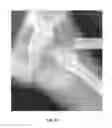 Fig. 48 - Method and apparatus for treating a joint, including the treatment of cam-type femoroacetabular impingement in a hip joint and pincer-type femoroacetabular impingement in a hip joint