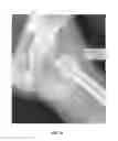 Fig. 49 - Method and apparatus for treating a joint, including the treatment of cam-type femoroacetabular impingement in a hip joint and pincer-type femoroacetabular impingement in a hip joint