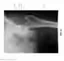Fig. 50 - Method and apparatus for treating a joint, including the treatment of cam-type femoroacetabular impingement in a hip joint and pincer-type femoroacetabular impingement in a hip joint
