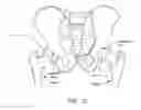 Fig. 03 - METHOD AND APPARATUS FOR RECONSTRUCTING A HIP JOINT, INCLUDING THE PROVISION AND USE OF A NOVEL ARTHROSCOPIC DEBRIDEMENT TEMPLATE FOR ASSISTING IN THE TREATMENT OF CAM-TYPE FEMOROACETABULAR IMPINGEMENT