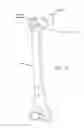 Fig. 04 - METHOD AND APPARATUS FOR RECONSTRUCTING A HIP JOINT, INCLUDING THE PROVISION AND USE OF A NOVEL ARTHROSCOPIC DEBRIDEMENT TEMPLATE FOR ASSISTING IN THE TREATMENT OF CAM-TYPE FEMOROACETABULAR IMPINGEMENT