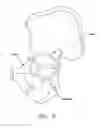 Fig. 06 - METHOD AND APPARATUS FOR RECONSTRUCTING A HIP JOINT, INCLUDING THE PROVISION AND USE OF A NOVEL ARTHROSCOPIC DEBRIDEMENT TEMPLATE FOR ASSISTING IN THE TREATMENT OF CAM-TYPE FEMOROACETABULAR IMPINGEMENT