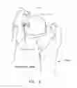 Fig. 09 - METHOD AND APPARATUS FOR RECONSTRUCTING A HIP JOINT, INCLUDING THE PROVISION AND USE OF A NOVEL ARTHROSCOPIC DEBRIDEMENT TEMPLATE FOR ASSISTING IN THE TREATMENT OF CAM-TYPE FEMOROACETABULAR IMPINGEMENT