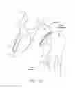 Fig. 11 - METHOD AND APPARATUS FOR RECONSTRUCTING A HIP JOINT, INCLUDING THE PROVISION AND USE OF A NOVEL ARTHROSCOPIC DEBRIDEMENT TEMPLATE FOR ASSISTING IN THE TREATMENT OF CAM-TYPE FEMOROACETABULAR IMPINGEMENT