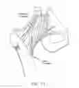 Fig. 12 - METHOD AND APPARATUS FOR RECONSTRUCTING A HIP JOINT, INCLUDING THE PROVISION AND USE OF A NOVEL ARTHROSCOPIC DEBRIDEMENT TEMPLATE FOR ASSISTING IN THE TREATMENT OF CAM-TYPE FEMOROACETABULAR IMPINGEMENT