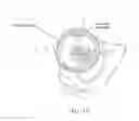 Fig. 16 - METHOD AND APPARATUS FOR RECONSTRUCTING A HIP JOINT, INCLUDING THE PROVISION AND USE OF A NOVEL ARTHROSCOPIC DEBRIDEMENT TEMPLATE FOR ASSISTING IN THE TREATMENT OF CAM-TYPE FEMOROACETABULAR IMPINGEMENT