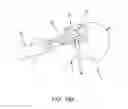 Fig. 20 - METHOD AND APPARATUS FOR RECONSTRUCTING A HIP JOINT, INCLUDING THE PROVISION AND USE OF A NOVEL ARTHROSCOPIC DEBRIDEMENT TEMPLATE FOR ASSISTING IN THE TREATMENT OF CAM-TYPE FEMOROACETABULAR IMPINGEMENT