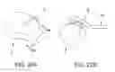 Fig. 26 - METHOD AND APPARATUS FOR RECONSTRUCTING A HIP JOINT, INCLUDING THE PROVISION AND USE OF A NOVEL ARTHROSCOPIC DEBRIDEMENT TEMPLATE FOR ASSISTING IN THE TREATMENT OF CAM-TYPE FEMOROACETABULAR IMPINGEMENT