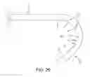 Fig. 30 - METHOD AND APPARATUS FOR RECONSTRUCTING A HIP JOINT, INCLUDING THE PROVISION AND USE OF A NOVEL ARTHROSCOPIC DEBRIDEMENT TEMPLATE FOR ASSISTING IN THE TREATMENT OF CAM-TYPE FEMOROACETABULAR IMPINGEMENT