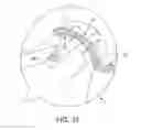 Fig. 35 - METHOD AND APPARATUS FOR RECONSTRUCTING A HIP JOINT, INCLUDING THE PROVISION AND USE OF A NOVEL ARTHROSCOPIC DEBRIDEMENT TEMPLATE FOR ASSISTING IN THE TREATMENT OF CAM-TYPE FEMOROACETABULAR IMPINGEMENT