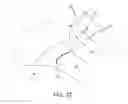 Fig. 41 - METHOD AND APPARATUS FOR RECONSTRUCTING A HIP JOINT, INCLUDING THE PROVISION AND USE OF A NOVEL ARTHROSCOPIC DEBRIDEMENT TEMPLATE FOR ASSISTING IN THE TREATMENT OF CAM-TYPE FEMOROACETABULAR IMPINGEMENT