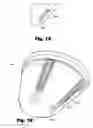 Fig. 15 - LOW-PROFILE SURGICAL ACCESS DEVICES WITH ANCHORING