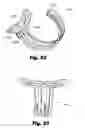 Fig. 17 - LOW-PROFILE SURGICAL ACCESS DEVICES WITH ANCHORING