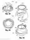 Fig. 28 - LOW-PROFILE SURGICAL ACCESS DEVICES WITH ANCHORING