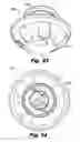 Fig. 31 - LOW-PROFILE SURGICAL ACCESS DEVICES WITH ANCHORING