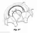 Fig. 33 - LOW-PROFILE SURGICAL ACCESS DEVICES WITH ANCHORING