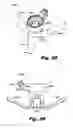 Fig. 34 - LOW-PROFILE SURGICAL ACCESS DEVICES WITH ANCHORING
