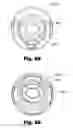Fig. 40 - LOW-PROFILE SURGICAL ACCESS DEVICES WITH ANCHORING