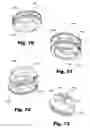 Fig. 41 - LOW-PROFILE SURGICAL ACCESS DEVICES WITH ANCHORING