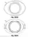 Fig. 55 - LOW-PROFILE SURGICAL ACCESS DEVICES WITH ANCHORING