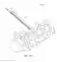 Fig. 15 - Method and device for endoscopic graft delivery using a slotted cannula