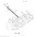 Fig. 17 - Method and device for endoscopic graft delivery using a slotted cannula