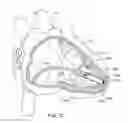 Fig. 04 - Delivery devices and wall apposition sensing